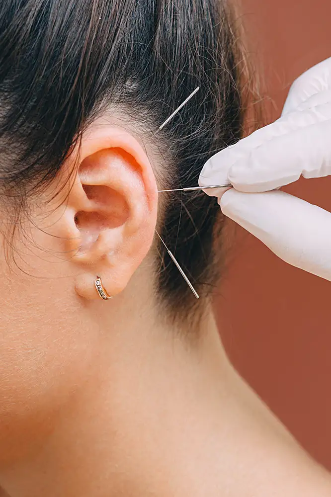Ear_Acupuncture